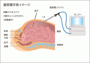 子宮筋腫の内視鏡手術で、病変に肉腫などのがんがあった場合、筋腫を切る器具ががんを腹部内でまき散らし、悪化させる恐れがあることが分かった。