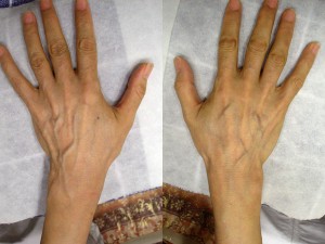 腕などで青く見えている静脈